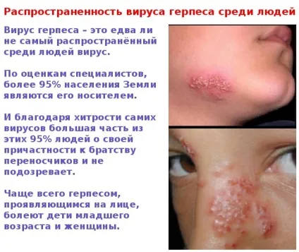 Герпес на обличчі - фото симптомів на різних стадіях (герпес) Герпес на обличчі - фото симптомів на різних стадіях