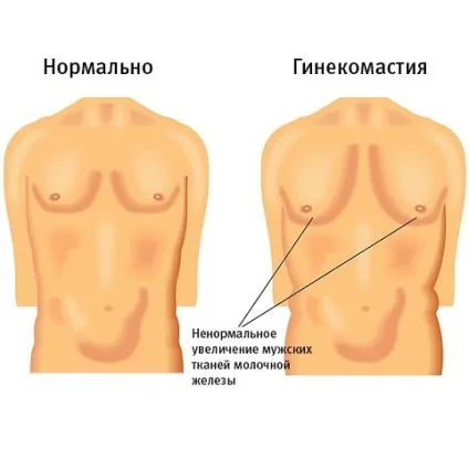 Гінекомастія що собою являє і які її симптоми (гінекомастія) Гінекомастія що собою являє і які її симптоми