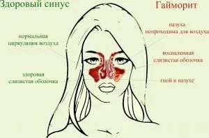 Гнійний гайморит лікування в домашніх умовах (домашніх) Гнійний гайморит лікування в домашніх умовах
