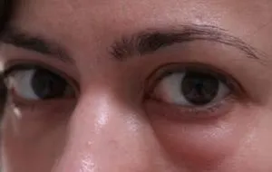 Грижі під очима причини, симптоми, способи лікування патології