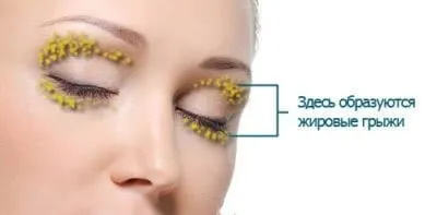 Грижі під очима причини, симптоми, способи лікування патології