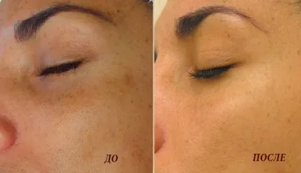 Hydrafacial - чистка особи