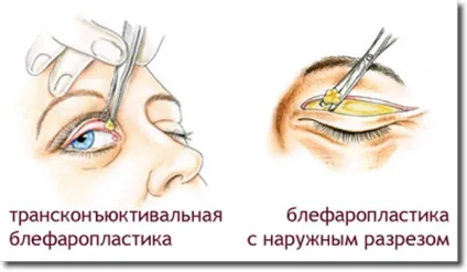 Грижа під очима (параорбітального) - як позбутися, як прибрати без операції, фото, нижньої повіки, (прибрати) Грижа під очима (параорбітального) - як позбутися, як прибрати без операції, фото, нижньої повіки,