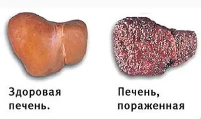 Інтоксикаційний синдром симптоми, лікування