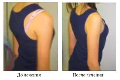 Викривлення хребта