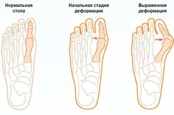 Як робити масаж при вальгусной установці стоп (робити) Як робити масаж при вальгусной установці стоп