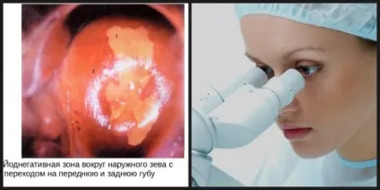 Йоднегативні зона, білі плями при кольпоскопії - що це
