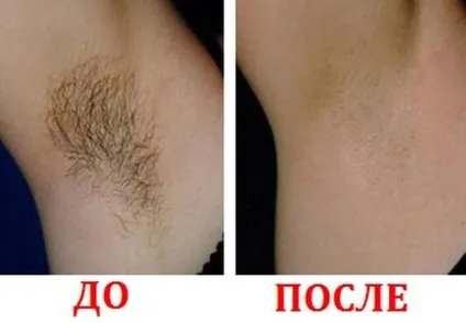 Як часто робити шугарінг бікіні, ніг, обличчя і пахв (робити) Як часто робити шугарінг бікіні, ніг, обличчя і пахв