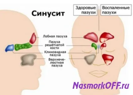 Як швидко і легко лікувати сильний нежить у дитини (лікувати сильний нежить дитина) Як швидко і легко лікувати сильний нежить у дитини