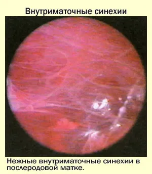Синехії у хлопчиків і дівчаток симптоми, причини, діагностика та лікування (дівчаток) Синехії у хлопчиків і дівчаток симптоми, причини, діагностика та лікування