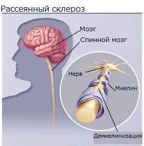Які бувають склерози і трохи про розсіяному склерозі (може привести летального) Які бувають склерози і трохи про розсіяному склерозі