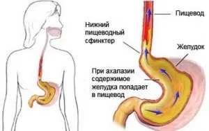 Як і чим лікувати біль в горлі при ковтанні (біль) Як і чим лікувати біль в горлі при ковтанні