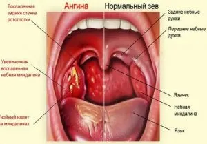 Як і чим лікувати біль в горлі при ковтанні (горлі) Як і чим лікувати біль в горлі при ковтанні