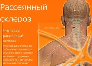 Які бувають склерози і трохи про розсіяному склерозі (може привести летального результату) Які бувають склерози і трохи про розсіяному склерозі