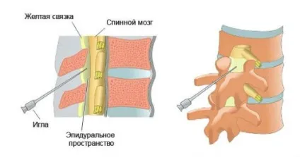 Які уколи при остеохондрозі поперекового відділу хребта можна робити (відділу) Які уколи при остеохондрозі поперекового відділу хребта можна робити