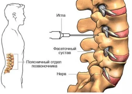 Які уколи при остеохондрозі поперекового відділу хребта можна робити (відділу) Які уколи при остеохондрозі поперекового відділу хребта можна робити