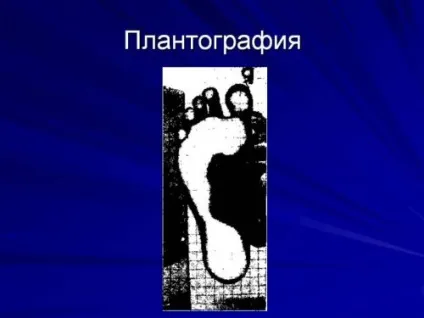 Які причини призводять до виникнення плоскостопості у дітей і дорослих (які) Які причини призводять до виникнення плоскостопості у дітей і дорослих