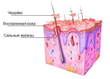 Як позбутися від сухої лупи лікування, шампуні, засоби (лікування) Як позбутися від сухої лупи лікування, шампуні, засоби