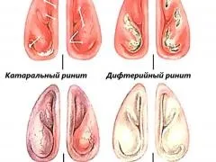 Як лікувати хронічний риніт, аптечні препарати і народні засоби (препарати) Як лікувати хронічний риніт, аптечні препарати і народні засоби