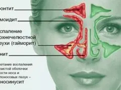 Як лікувати хронічний риніт, аптечні препарати і народні засоби (препарати) Як лікувати хронічний риніт, аптечні препарати і народні засоби