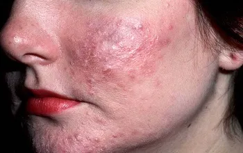 Як лікувати розацеа на обличчі причини, симптоми, апаратні методи, лікарські препарати, народні (апаратні) Як лікувати розацеа на обличчі причини, симптоми, апаратні методи, лікарські препарати, народні