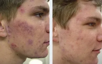 Як лікувати розацеа на обличчі причини, симптоми, апаратні методи, лікарські препарати, народні (акне) Як лікувати розацеа на обличчі причини, симптоми, апаратні методи, лікарські препарати, народні