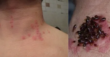 Як відрізнити укус комахи від серйозного захворювання визначаю неозброєним оком (комахи) Як відрізнити укус комахи від серйозного захворювання визначаю неозброєним оком
