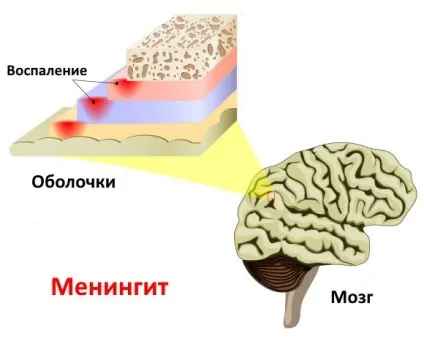 Як передається менінгіт від людини до людини, шляхи зараження (людині) Як передається менінгіт від людини до людини, шляхи зараження