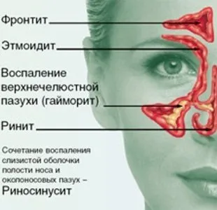 Як правильно промивати ніс грудничку аквамарисом (промивати) Як правильно промивати ніс грудничку аквамарисом
