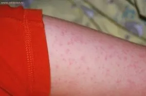 Висип на стегнах у дитини