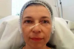 Як зробити вилиці на обличчі (зробити вилиці особі) Як зробити вилиці на обличчі