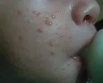 Як прибрати гнійні і водяні прищі на ногах (прищі) Як прибрати гнійні і водяні прищі на ногах