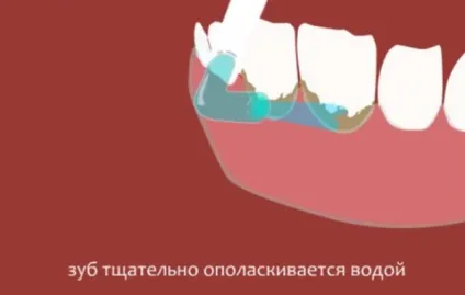 Як видаляють зубний камінь в стоматології дізнайся детально про методи чистки!