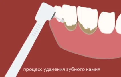 Як видаляють зубний камінь в стоматології дізнайся детально про методи чистки!
