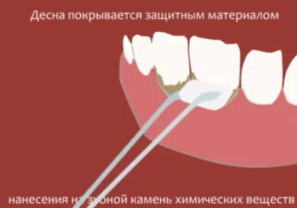 Як видаляють зубний камінь в стоматології дізнайся детально про методи чистки!
