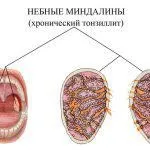 Як вилікувати хронічний тонзиліт раз і назавжди в домашніх умовах народними засобами у (тонзиліт) Як вилікувати хронічний тонзиліт раз і назавжди в домашніх умовах народними засобами у