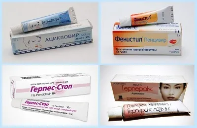 Як вилікувати герпес назавжди чи можна і як повністю позбутися від вірусу