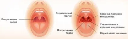Як вилікувати хронічний тонзиліт раз і назавжди в домашніх умовах народними засобами у (вилікувати) Як вилікувати хронічний тонзиліт раз і назавжди в домашніх умовах народними засобами у