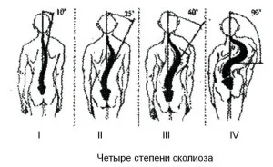 S-подібний сколіоз 1 ступеня симптоми і лікування, вправи (ступеня) S-подібний сколіоз 1 ступеня симптоми і лікування, вправи