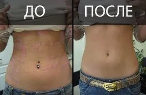 Смертельний чи псоріаз, як жити з хворобою і чи впливає псоріаз на тривалість життя (впливає) Смертельний чи псоріаз, як жити з хворобою і чи впливає псоріаз на тривалість життя