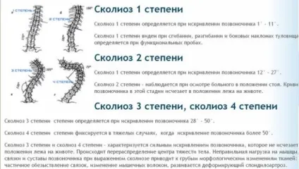 S подібний сколіоз грудного, поперекового відділу хребта 1, 2, 3 і 4 ступеня (s подібний сколіоз 2 ступеня) S подібний сколіоз грудного, поперекового відділу хребта 1, 2, 3 і 4 ступеня
