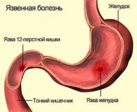 Кисла відрижка причини