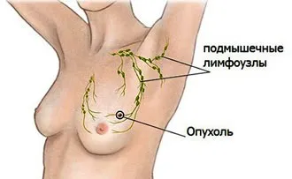 Кіста молочної залози види, причини, симптоми і діагностика (симптоми) Кіста молочної залози види, причини, симптоми і діагностика