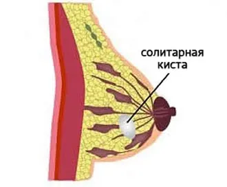 Кіста молочної залози види, причини, симптоми і діагностика (кіста) Кіста молочної залози види, причини, симптоми і діагностика
