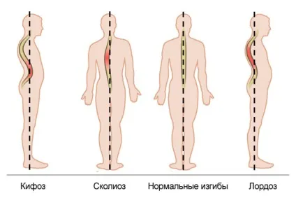 Кіфоз, лордоз і сколіоз хребта (лордоз) Кіфоз, лордоз і сколіоз хребта