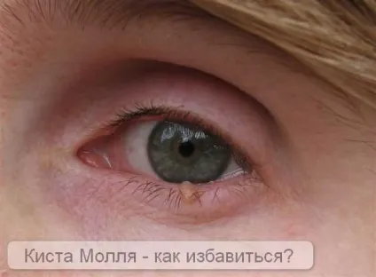 Кіста Молля на столітті - лікування недуги (Вірус папіломи людини) Кіста Молля на столітті - лікування недуги