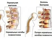 Кокцігодінія симптоми і лікування в домашніх умовах (кокцигодинія) Кокцігодінія симптоми і лікування в домашніх умовах