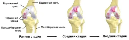 Коксартроз тазостегнового суглоба 1, 2 і 3 ступеня ознаки і лікування (тазостегнового) Коксартроз тазостегнового суглоба 1, 2 і 3 ступеня ознаки і лікування