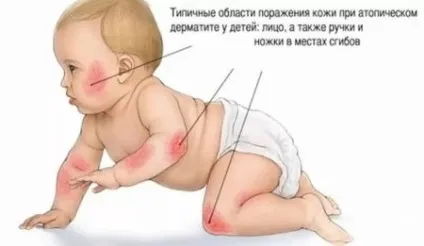 Комаровський атопічний дерматит у дітей