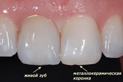 Коронка на зуб як ставлять, боляче чи ні, які коронки краще встановити (коронка) Коронка на зуб як ставлять, боляче чи ні, які коронки краще встановити